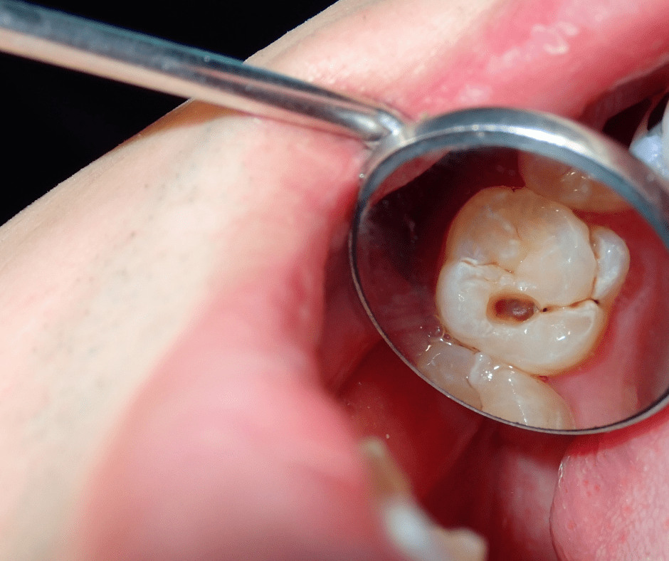 Carilles dentals
